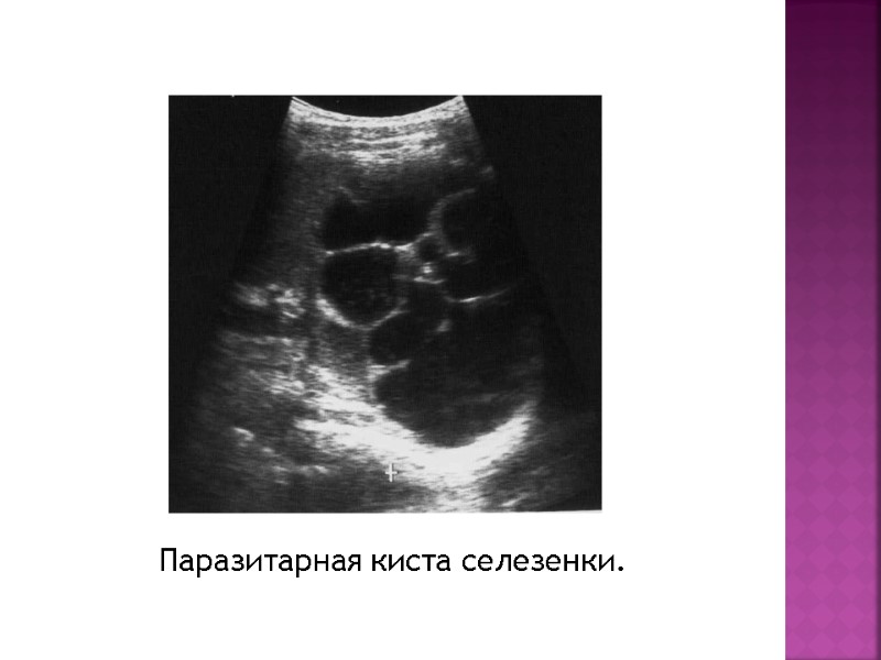 Паразитарная киста селезенки.